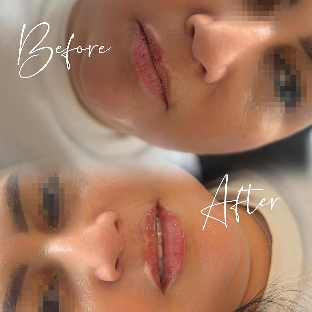 Lip filler before and after transformation, BellasGlow Beauty