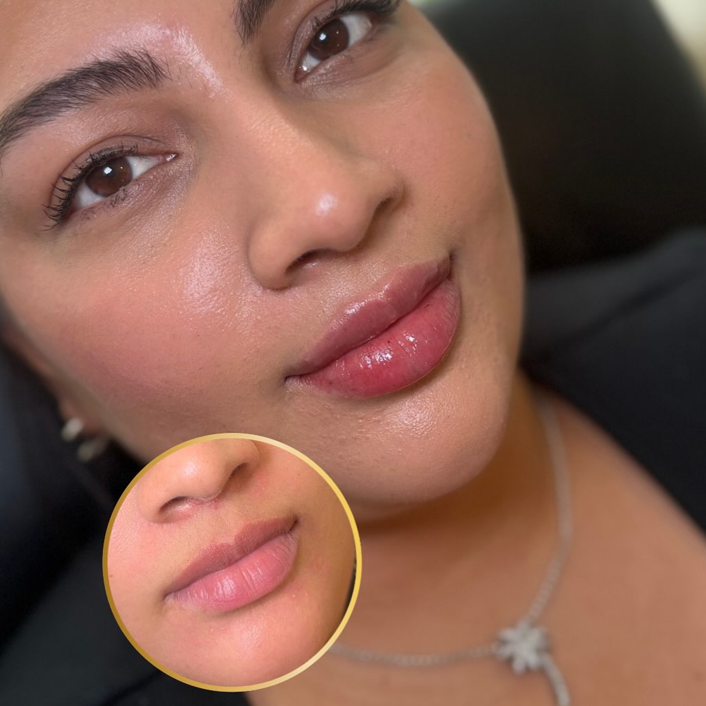 Subtle lip enhancement result, BellasGlow Beauty client