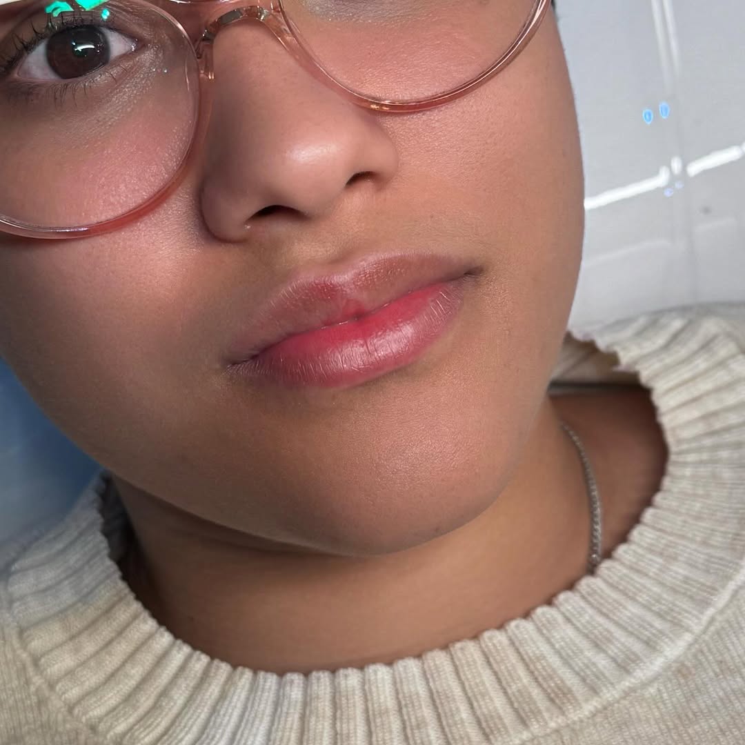 Lip filler treatment result, natural enhancement, BellasGlow Beauty