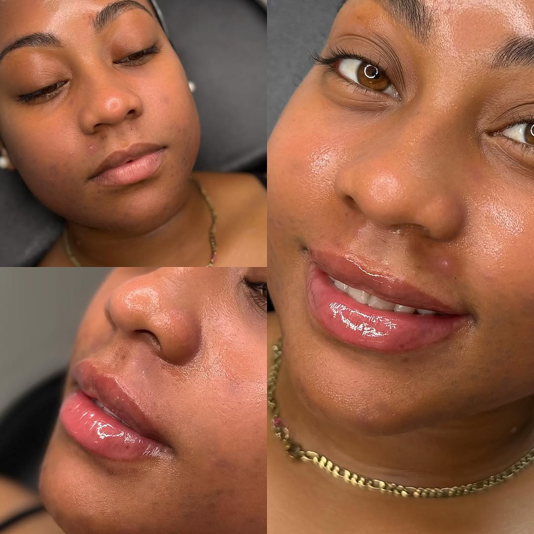 Natural lip filler result close-up, BellasGlow Beauty client