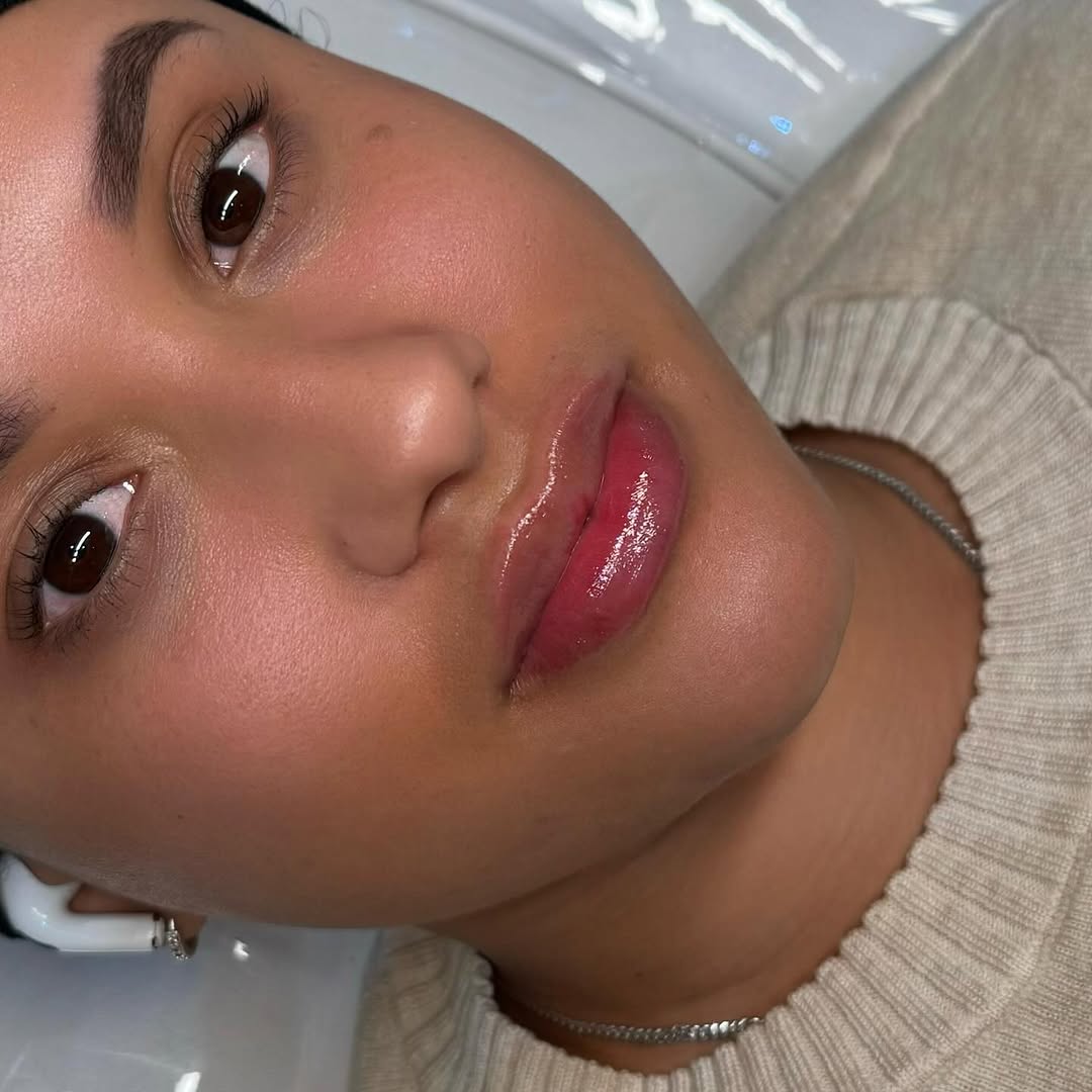 Natural lip filler result, close-up, BellasGlow Beauty London